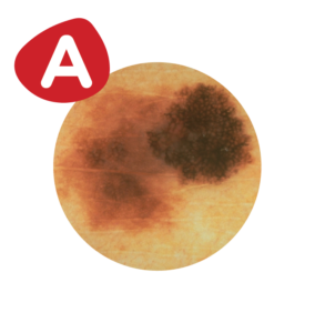 MoleMapping_A