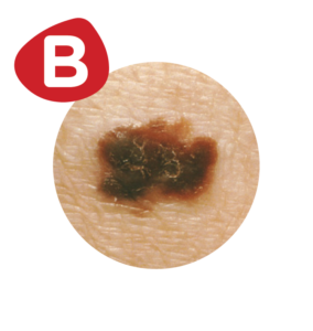 MoleMapping_B